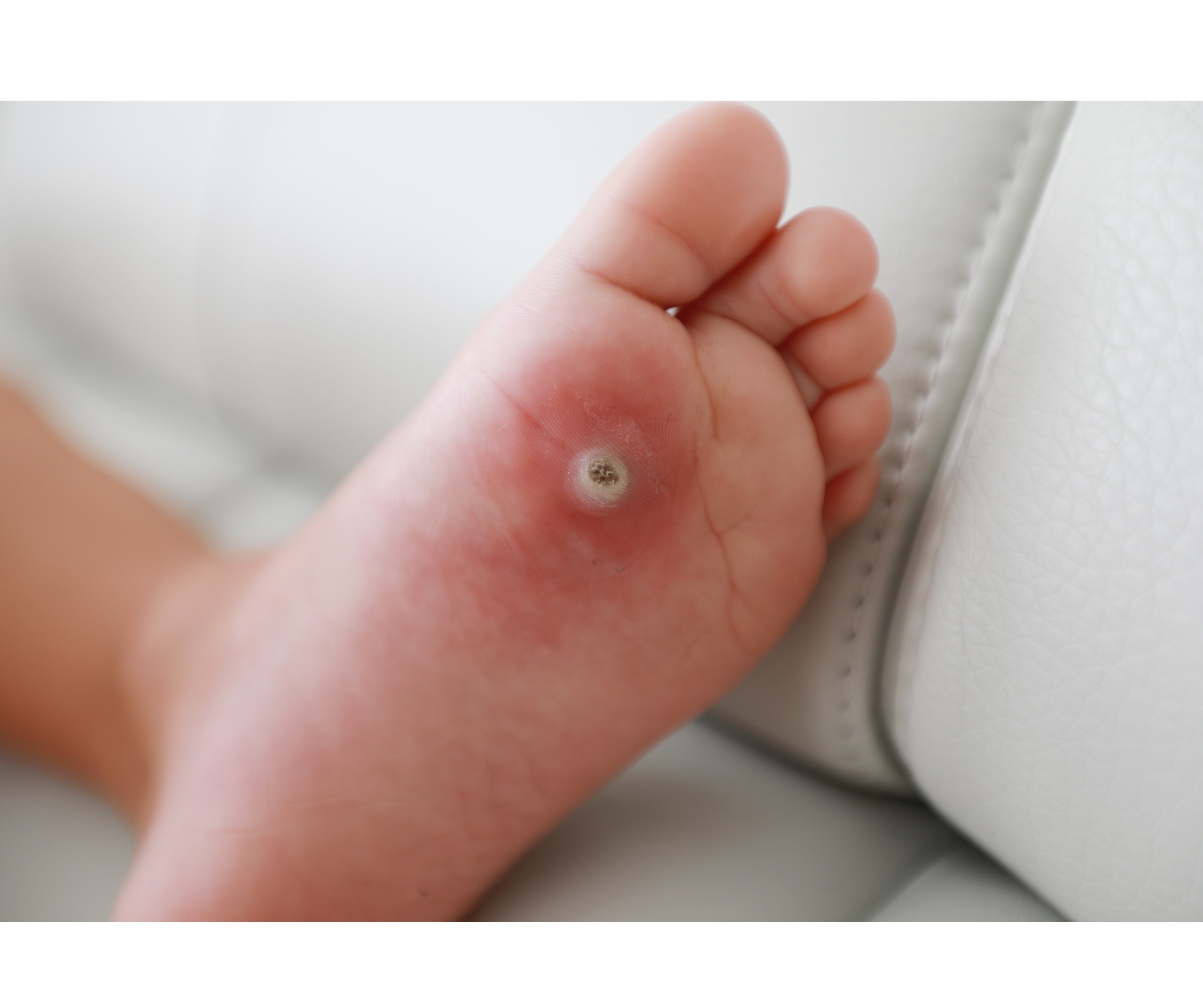 Varicose Treatment